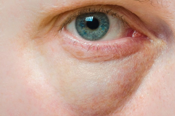 Dấu hiệu gan nhiễm mỡ trên khuôn mặt-1