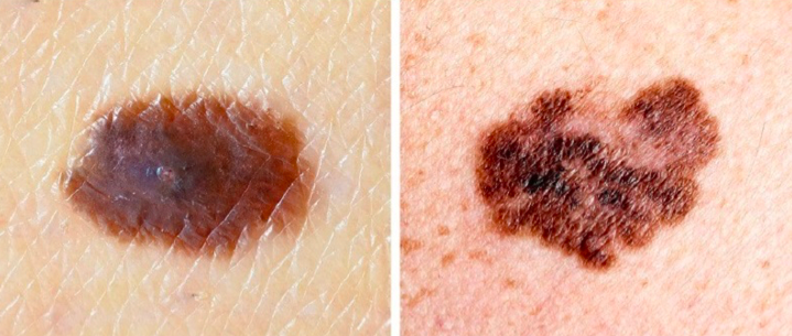 Người đàn ông Hà Nội phát hiện ung thư từ nốt ruồi phong thủy-2