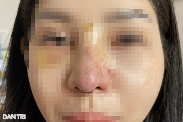 Bác sĩ tiktok sửa mũi 100 triệu đồng, cô gái xinh đẹp bị tai biến nặng nề-2