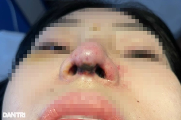 Bác sĩ tiktok sửa mũi 100 triệu đồng, cô gái xinh đẹp bị tai biến nặng nề-3