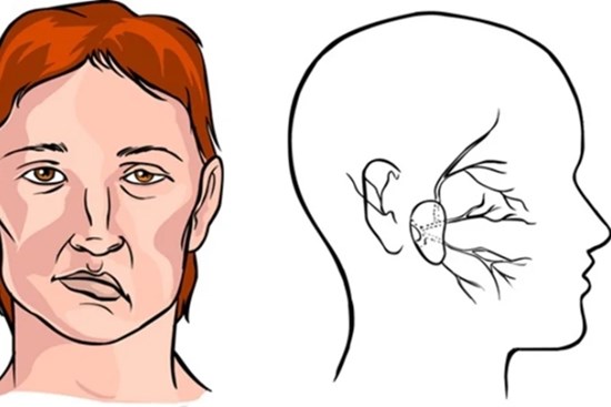 Cách xử lý khi bị trúng gió