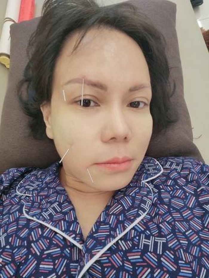 Việt Hương bị méo mặt, toàn thân phủ kín bởi 50 cây kim châm cứu-1