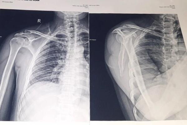 Say thuốc lào, người đàn ông ngã gãy xương đòn vai-2