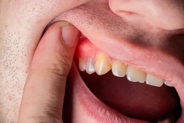 3 màu sắc ở răng là dấu hiệu cảnh báo căn bệnh dẫn đến rụng răng, thậm chí ung thư-2