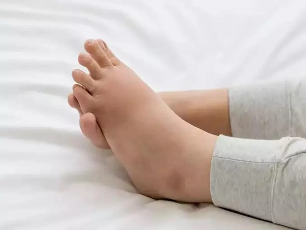 Dấu hiệu ở bàn chân cảnh báo gan đang suy yếu-1