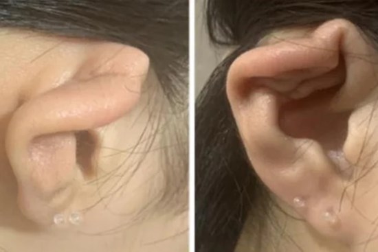 Nữ sinh 15 tuổi xỏ lỗ tai gây viêm màng sụn, biến dạng vành tai, chuyên gia cảnh báo