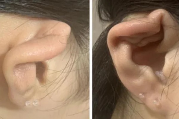 Nữ sinh 15 tuổi xỏ lỗ tai gây viêm màng sụn, biến dạng vành tai, chuyên gia cảnh báo-1