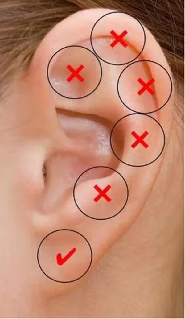 Nữ sinh 15 tuổi xỏ lỗ tai gây viêm màng sụn, biến dạng vành tai, chuyên gia cảnh báo-2