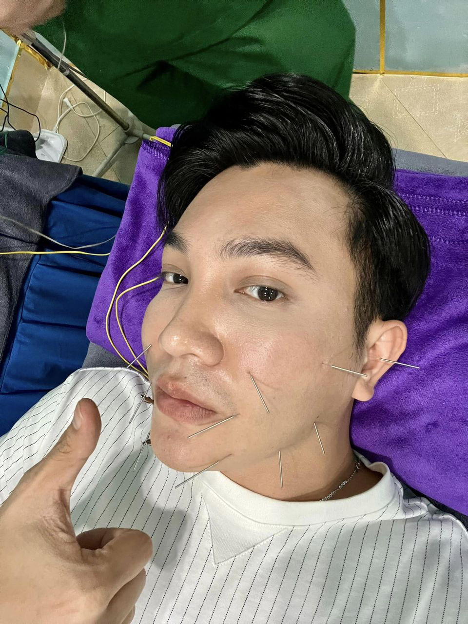 Bị liệt cơ mặt giống Hari Won, Việt Hương: Nam MC tiết lộ sự nguy hiểm của bệnh-1