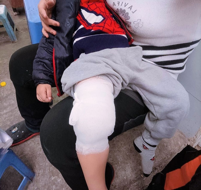Trẻ 3 tuổi ở Hà Nội bị gãy chân sau khi đi học, phụ huynh yêu cầu làm rõ-1