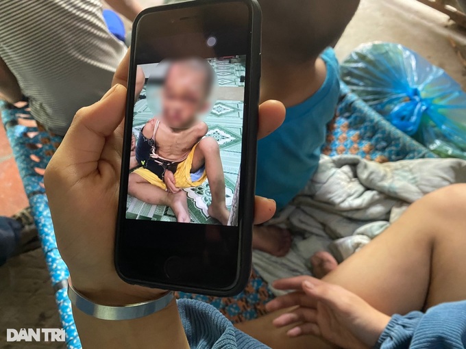 Cuộc giải cứu bé trai 2 tuổi nghi bị bố mẹ đổ nước sôi, châm thuốc ở TPHCM-2