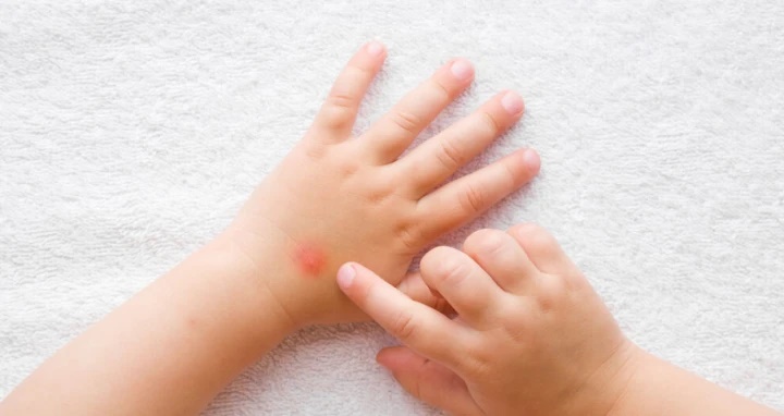 Mẹo chống muỗi đốt đơn giản và hiệu quả-2