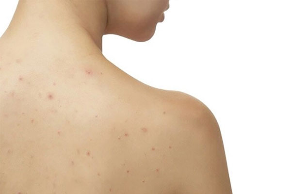 Bác sĩ da liễu tư vấn: Cần làm gì khi lưng bị mụn trứng cá?-1