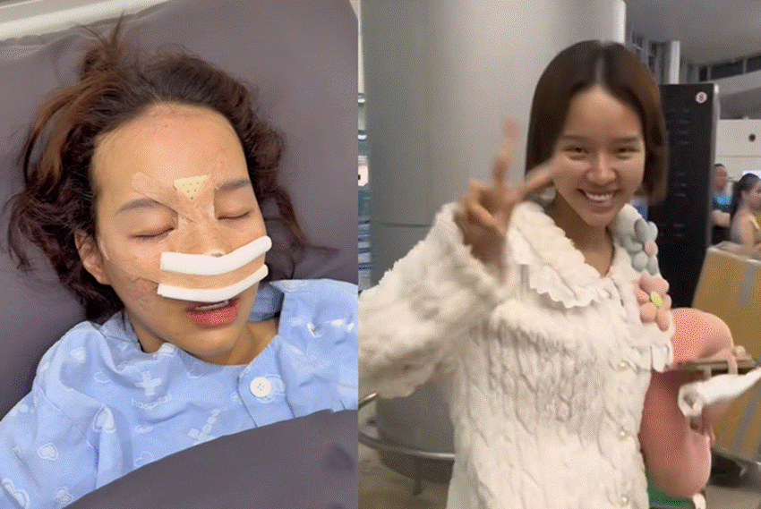 TikToker Việt vịt hóa thiên nga nhờ chi 300 triệu đồng sang Hàn sửa mũi-1