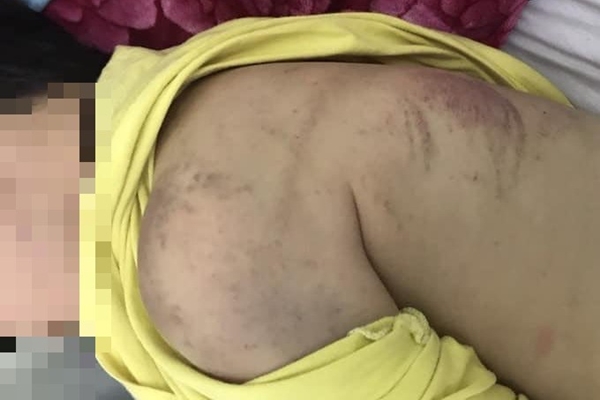 Bé 2 tuổi bị bạo hành nhập viện: Đừng coi đánh mắng trẻ là chuyện nhà người ta-2