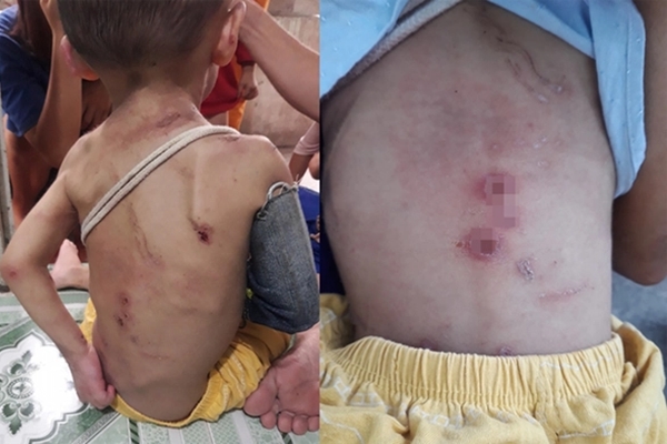 Bé trai 2 tuổi nghi bạo hành tại Hóc Môn hiện ra sao?-2