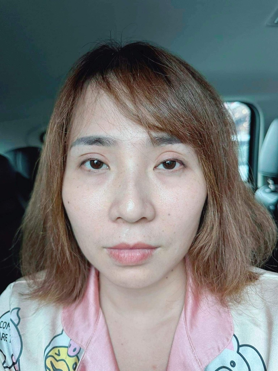 Hào hứng cắt mí, khốn khổ sửa lại-3