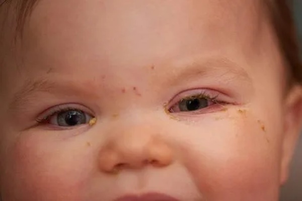 Triệu chứng mới của COVID-19 xuất hiện ở mắt-1