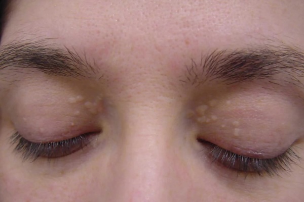 3 dấu hiệu ở mắt cảnh báo đột quỵ, ung thư ghé thăm-1