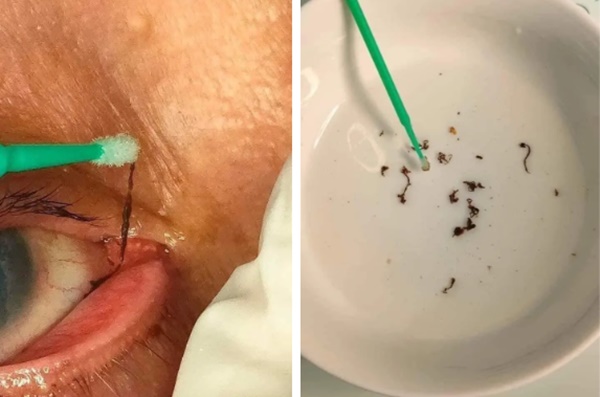 Dịch vụ bắt sâu mắt, sán mắt tại các spa khiến nhiều chị em hứng thú, chuyên gia cảnh báo 3 sự thật-4