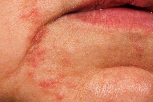 Thấy 6 dấu hiệu này trên khuôn mặt, hãy cẩn thận với gan nhiễm mỡ-3