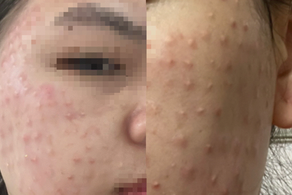 Mặt như tổ ong sau buổi tiêm chất độc quyền làm đẹp da miễn phí-2