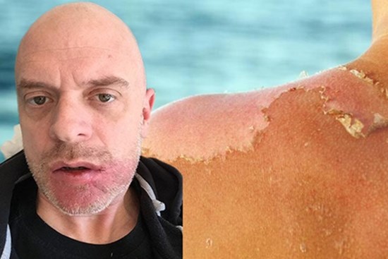 Người đàn ông mắc ung thư da nặng vì 1 thói quen nhiều người mắc vào mùa hè