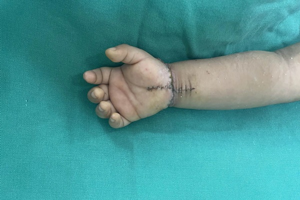 Nối bàn tay bị đứt lìa do tai nạn cho bé trai 21 tháng tuổi-2