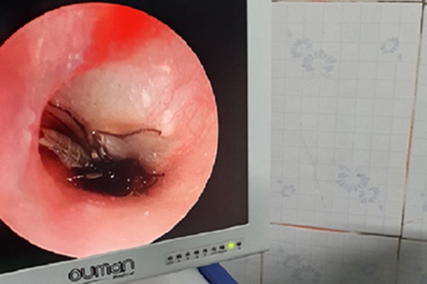 Bác sĩ phát hiện con gián còn sống trong tai bé 2 tuổi-1