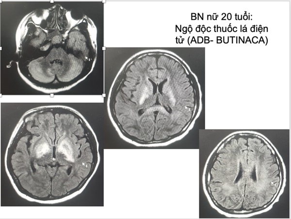 Nhiều người trẻ hôn mê, nguy kịch do ngộ độc thuốc lá điện tử-2