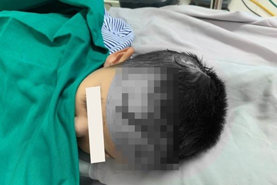 Bé trai 2 tuổi bị chó nhà cắn rách da đầu, mặt