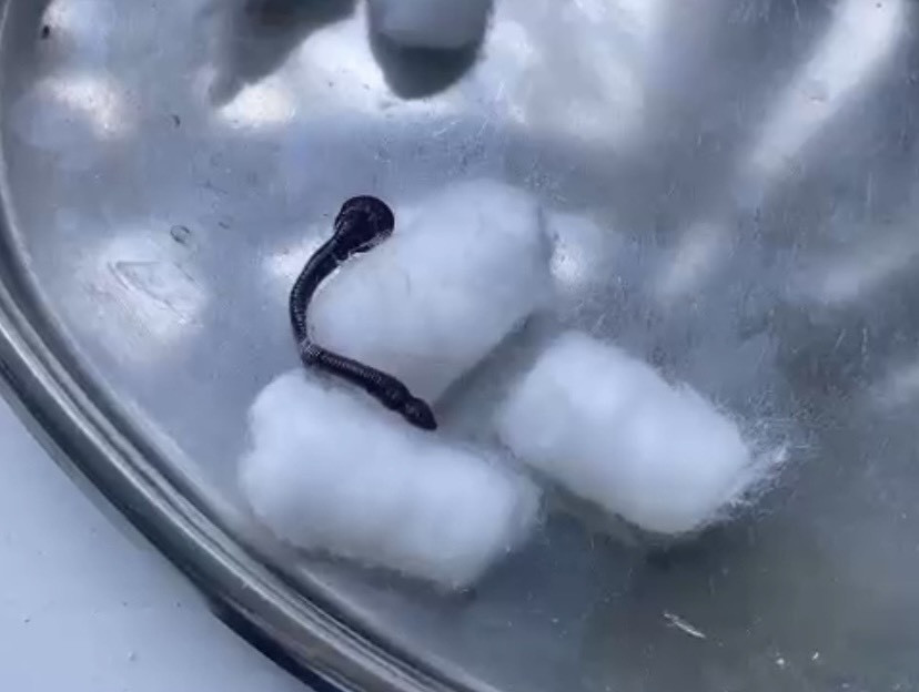 Liên tục chảy máu cam, người phụ nữ phát hiện đỉa trong mũi-1