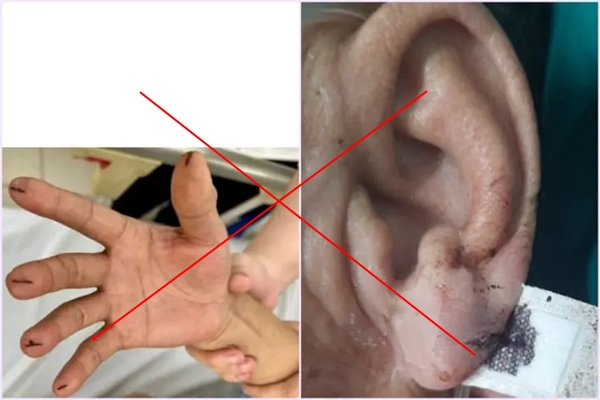 Sau khi tắm, bé gái 8 tuổi ở Phú Thọ bị đột quỵ-2