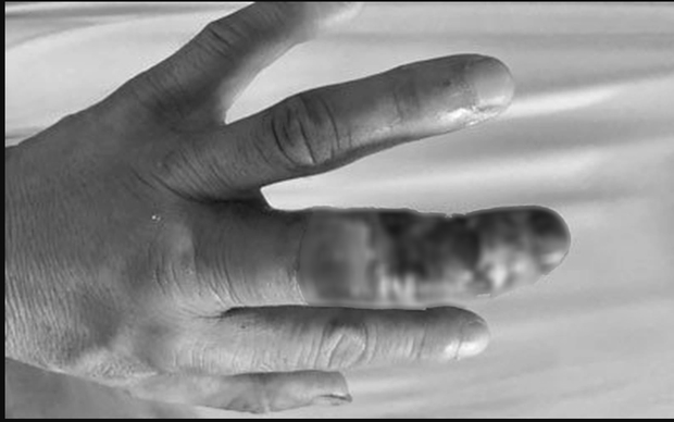 Hoại tử phải cắt bỏ ngón tay do đắp thuốc nam vào vết rắn cắn-1