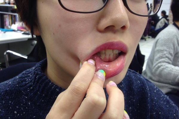 Bác sĩ nha khoa tiết lộ 4 biểu hiện là báo động đỏ” của bệnh ung thư miệng-4