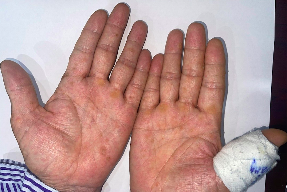 Phát hiện ung thư từ dấu hiệu lạ ở bàn tay-1