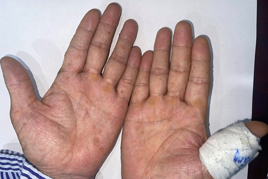 Phát hiện ung thư từ dấu hiệu lạ ở bàn tay