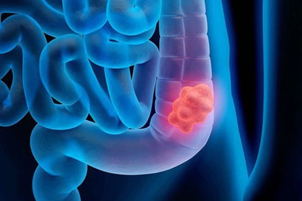 Người đàn ông 41 tuổi phát hiện mắc ung thư đại tràng giai đoạn cuối chỉ từ một triệu chứng-2