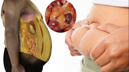 7 dấu hiệu sớm cảnh báo bạn bị gan nhiễm mỡ, đây là cách phòng ngừa bệnh hiệu quả nhất-1