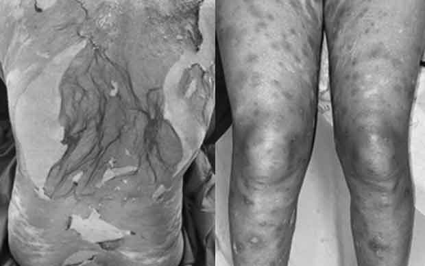 Dị ứng thuốc nặng sau khi dùng thuốc nam, thuốc đông y-1