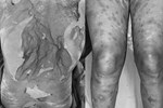 Hình ảnh bàn tay gây ám ảnh của bệnh nhân dị ứng thuốc kháng lao-2