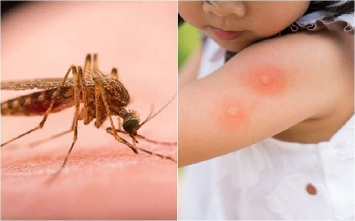 Mẹo hay giúp giảm ngứa khi bị muỗi đốt-1