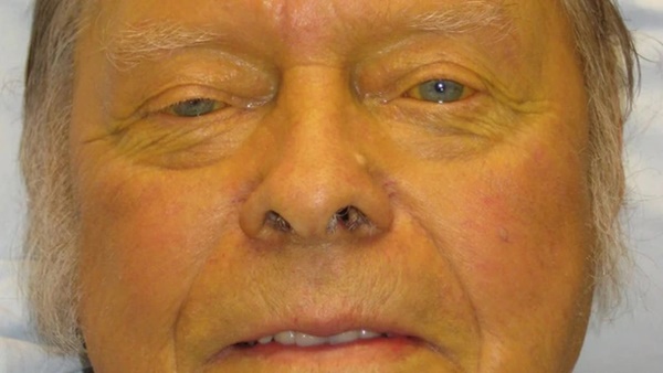 2 dấu hiệu trên da có thể báo hiệu ung thư gan, nếu thấy cần đi khám ngay-2