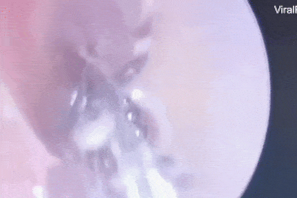 Clip: Kinh dị cảnh nhện làm tổ, giăng tơ trong tai người đàn ông-1