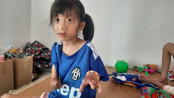 Sức khoẻ của 3 nạn nhân nhỏ tuổi trong vụ nổ kinh hoàng tại Nghệ An sau hơn 1 tháng điều trị-2