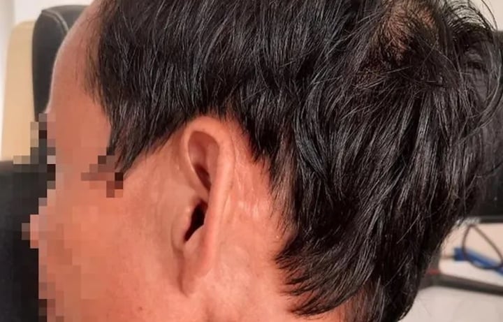 Hàng chục con giòi làm tổ trong tai người đàn ông ở Quảng Trị-2