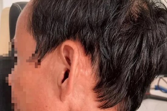 Hàng chục con giòi làm tổ trong tai người đàn ông ở Quảng Trị