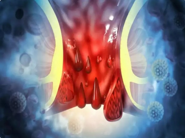 4 triệu chứng báo động đỏ của ung thư ruột kết ở người dưới 50 tuổi-3