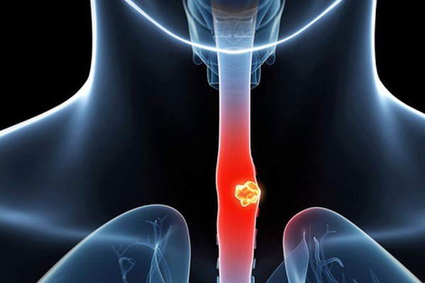 Trào ngược dạ dày thực quản có chuyển thành ung thư không?-1