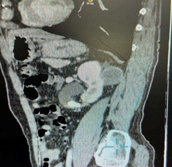 Dấu hiệu giúp người đàn ông phát hiện bệnh ung thư-2